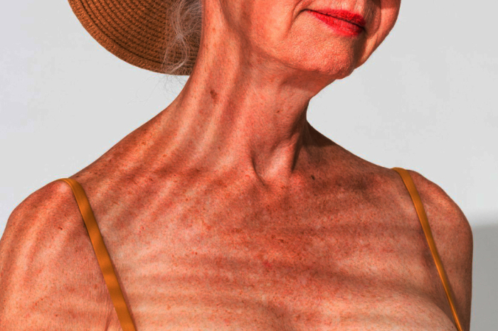 Manchas brancas na pele podem estar ligadas ao excesso de sol ao longo da vida